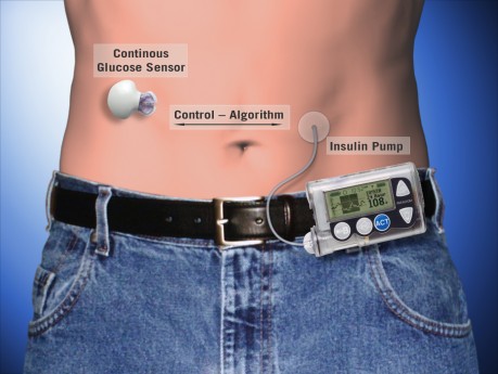 Insulin-Pump